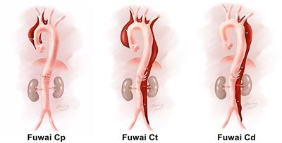 A New Aortic Arch Dissection Classification: The Fuwai Classification